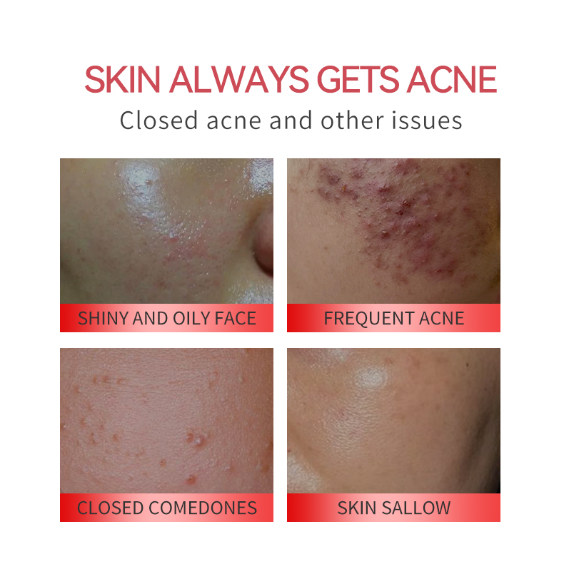 OEM ODM SA Salicylic Acid Acne Treatment Serum Clear Breakouts Shrink Pores Fade Post Acne Marks Oil Balancing Facial Essence(pic2)